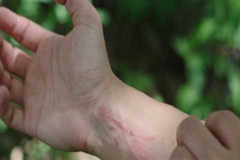 How do you get rid of poison ivy overnight?